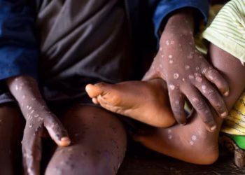 Mpox au Sénégal : 2 nouveaux cas confirmés